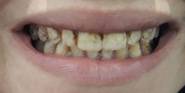 natrual teeth