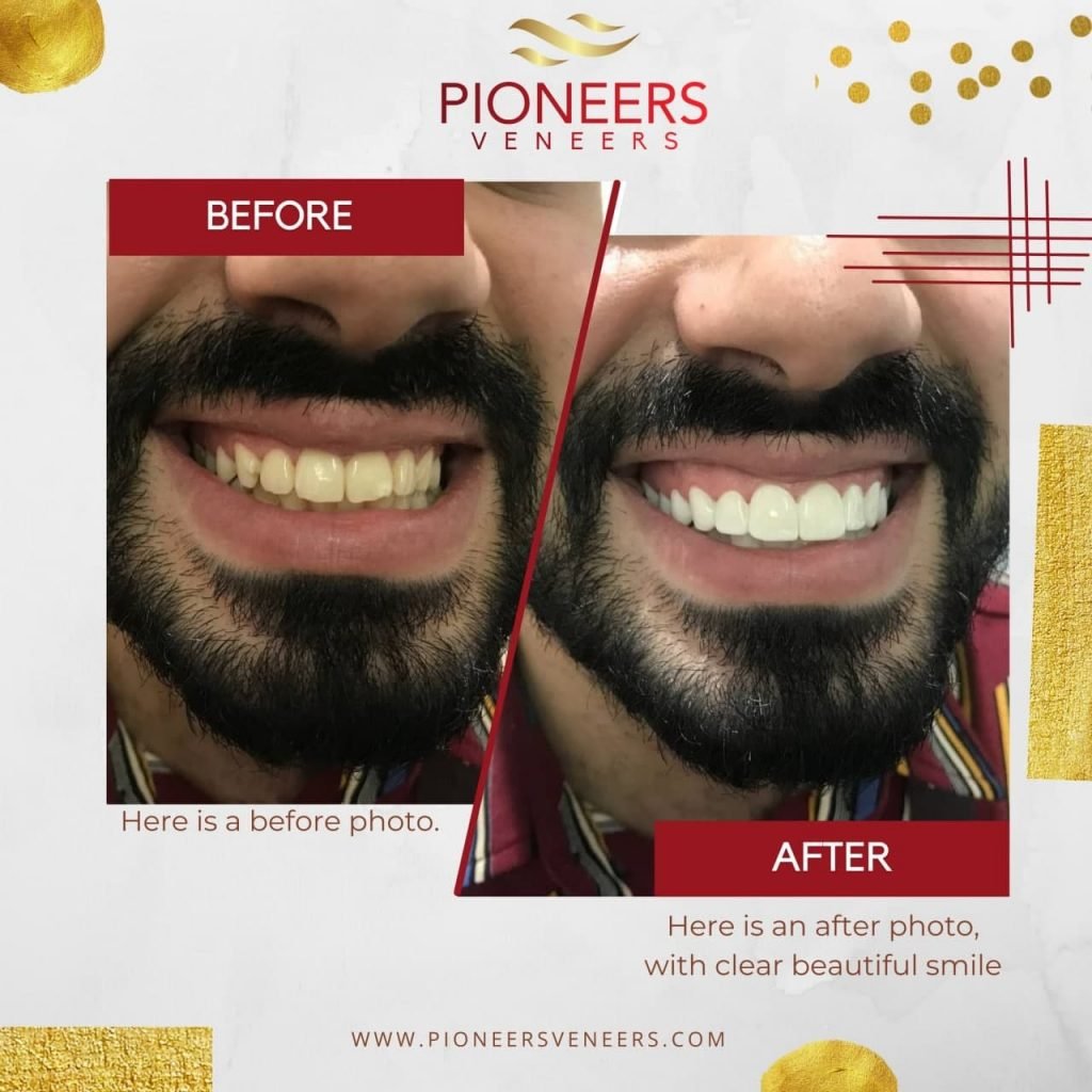 How To Get Your Best Snap On Veneers Best Snap On Veneers