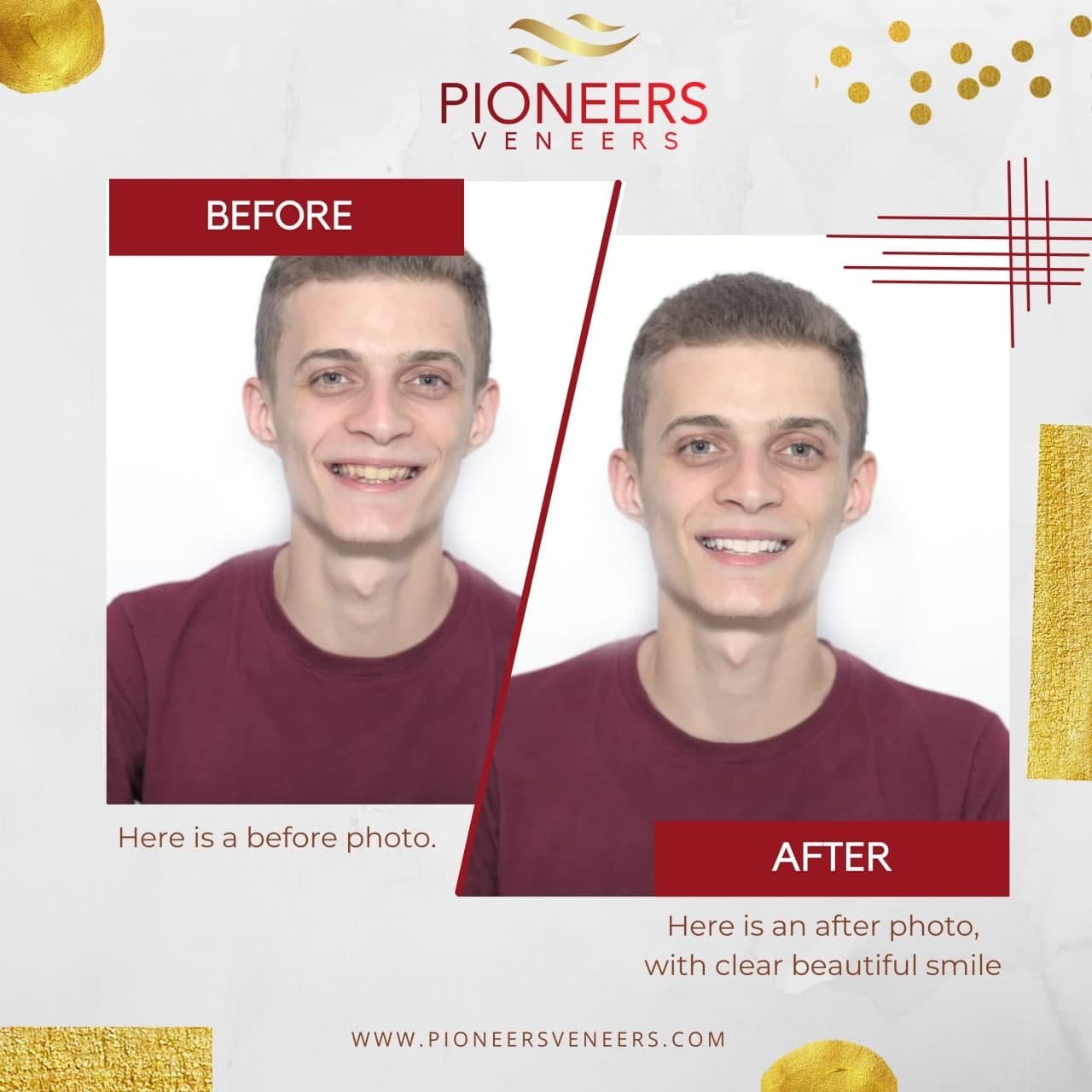 before and after pioneers veneers