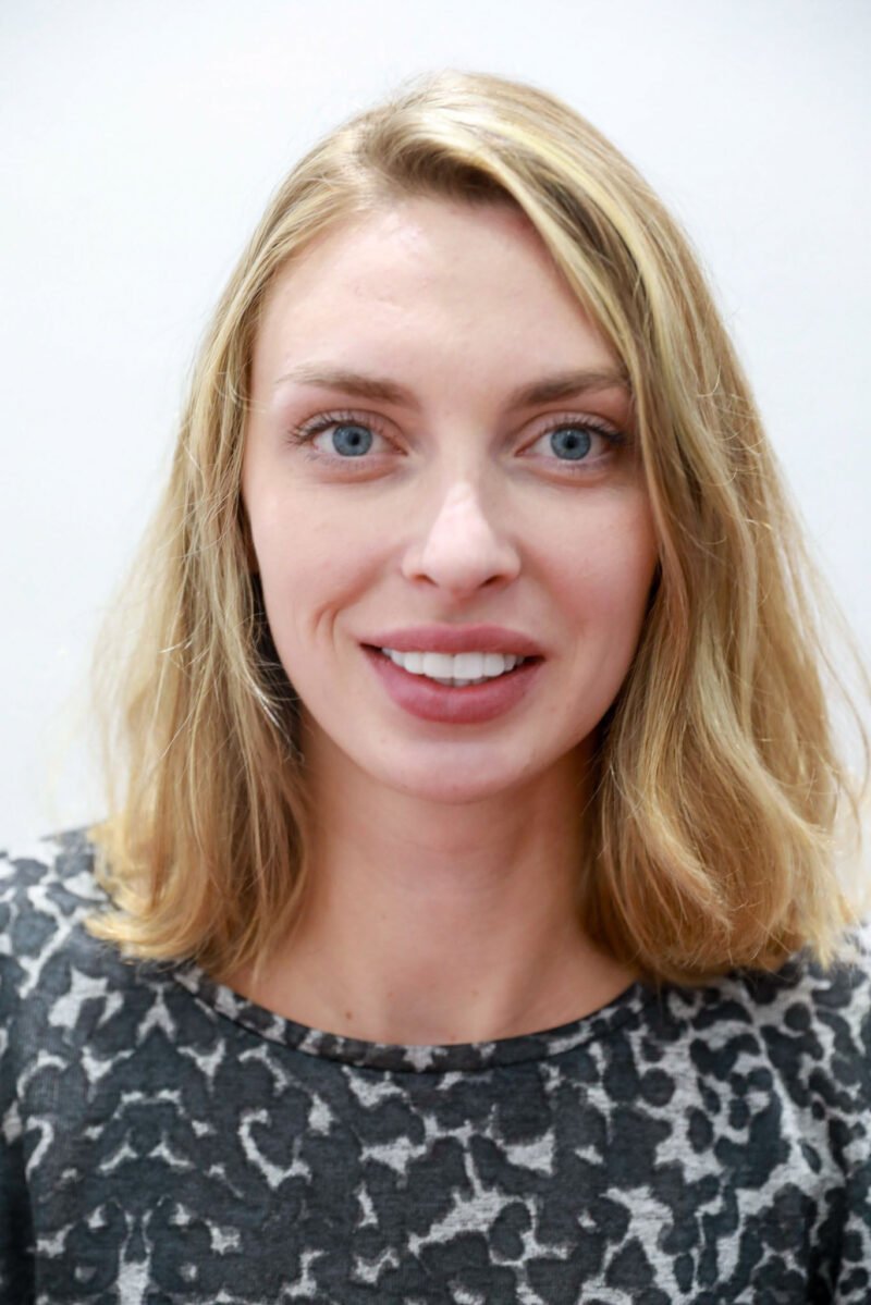 upper veneers