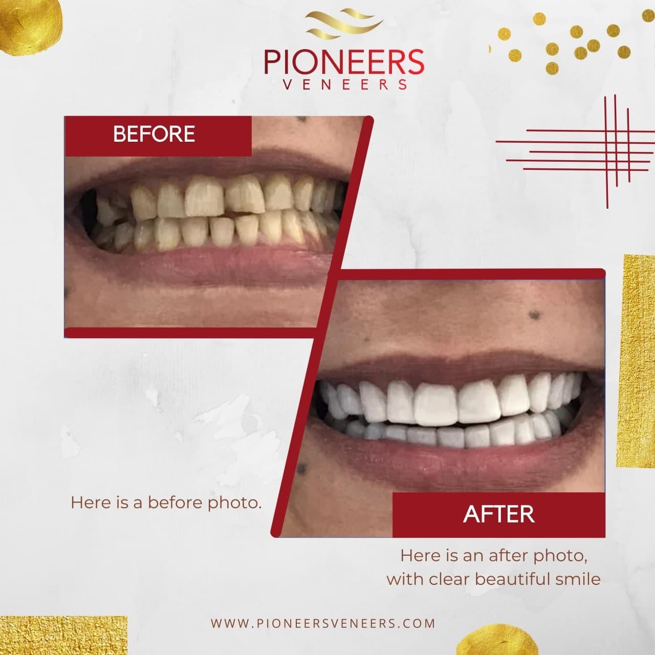 pioneers veneers