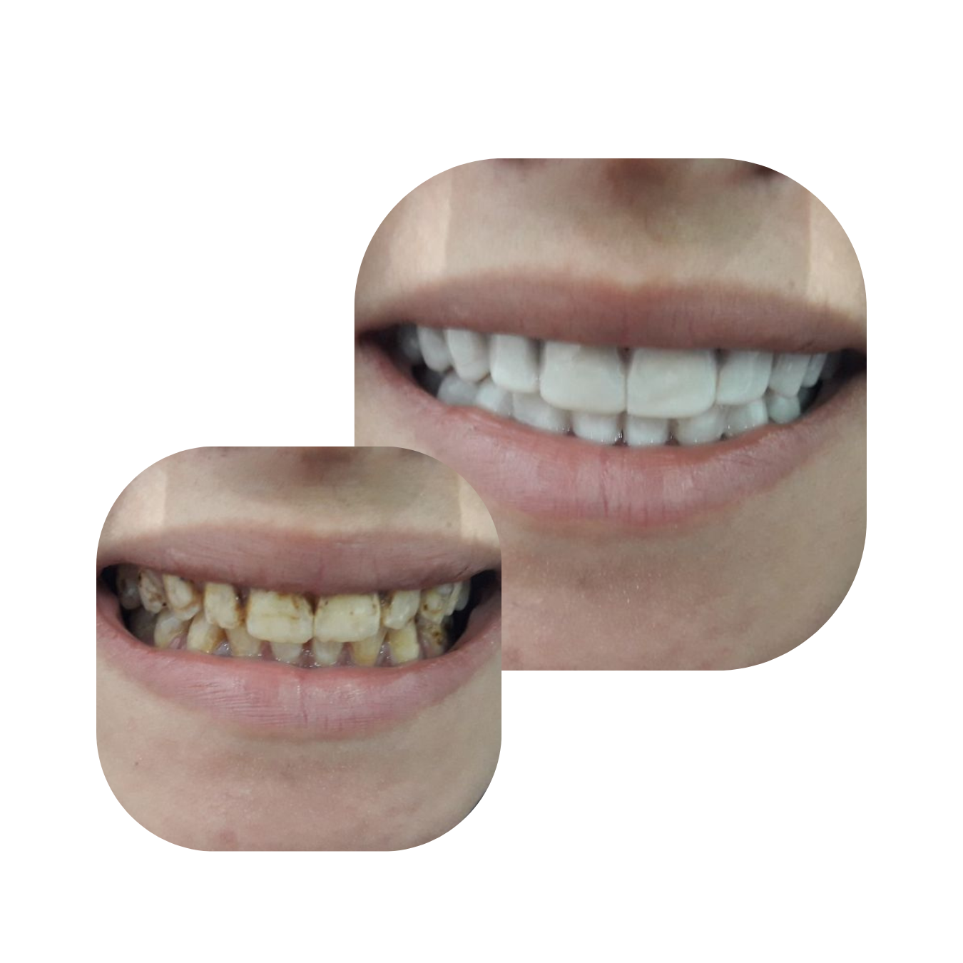 before and after snap on veneers