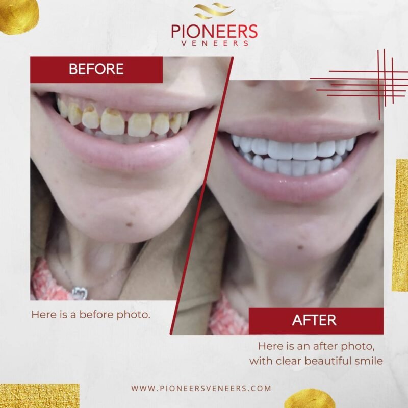 How To Get Your Best Snap On Veneers Best Snap On Veneers