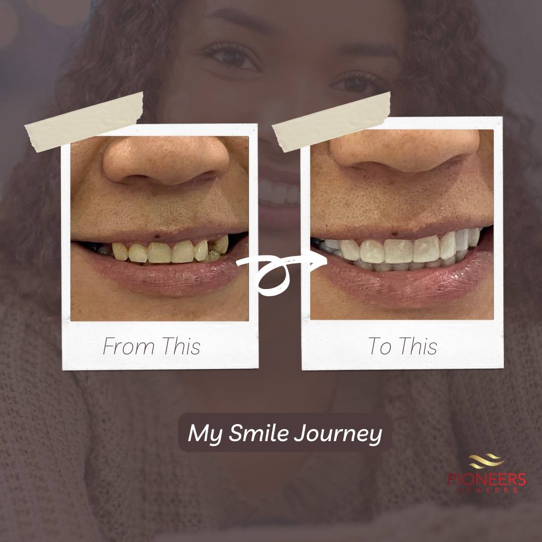 Best Snap On Veneers In 2023 Snap On Veneers