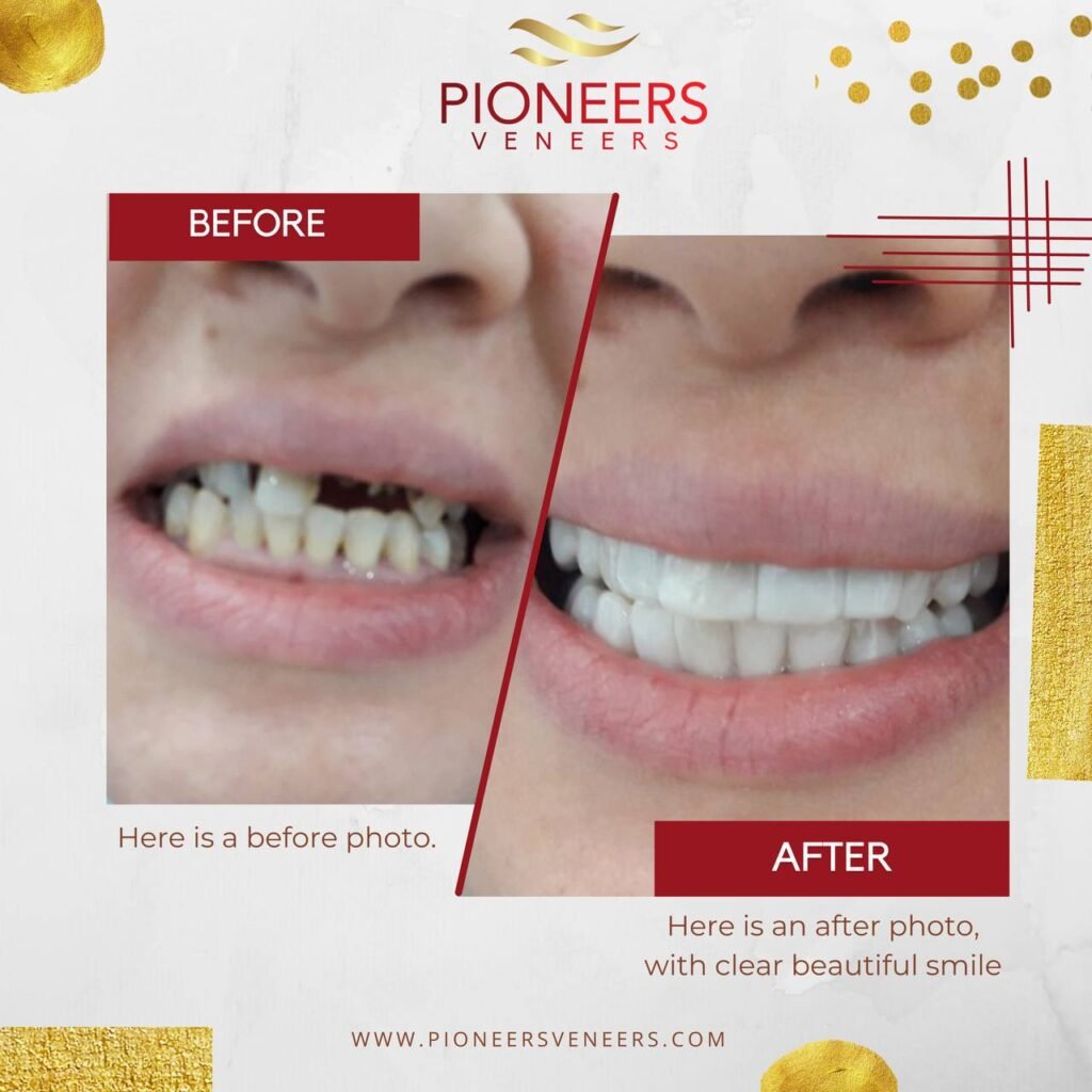 How To Get Your Best Snap On Veneers Best Snap On Veneers