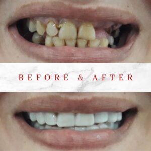 best snap on veneers for missing teeth 