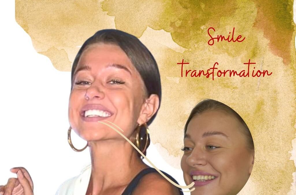 smile transformation snap on veneers