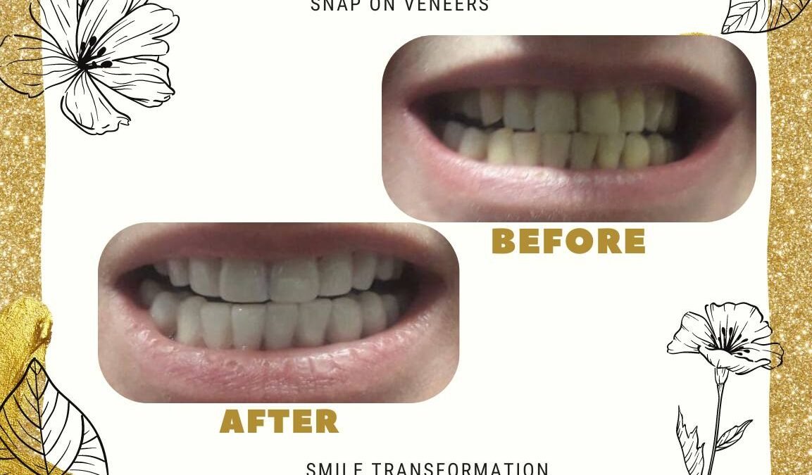 snap on veneers before and after