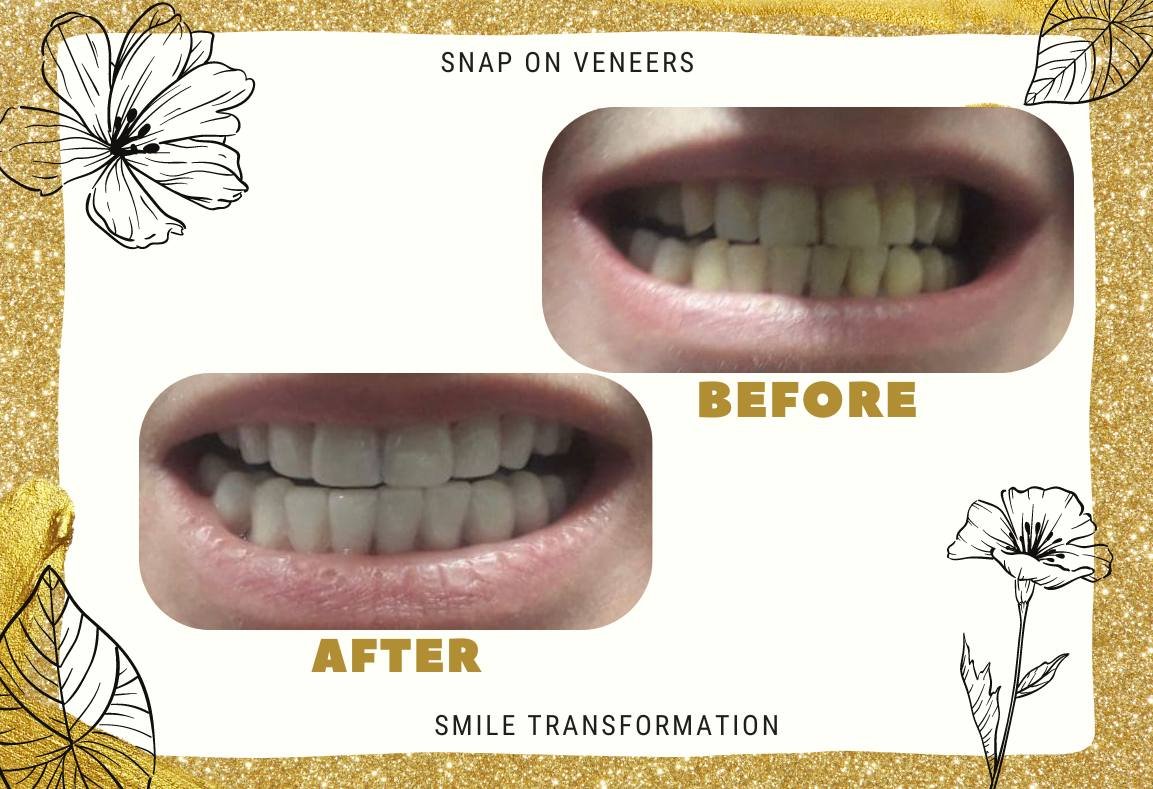 Snap On Veneers Full Guide From A To Z