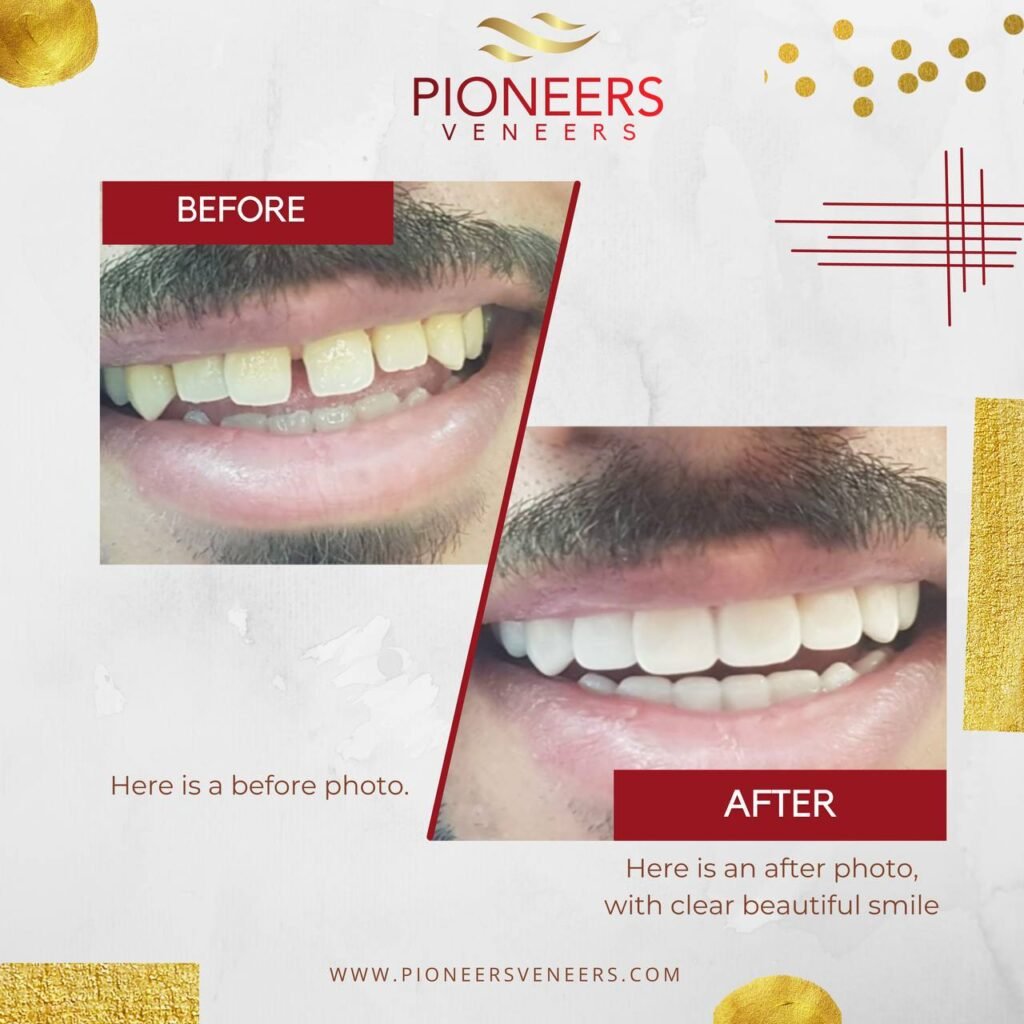 snap on veneers for yellowish teeth