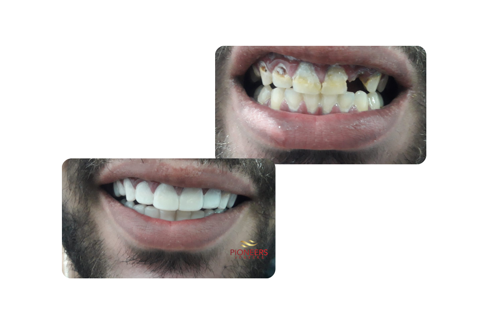 Snap on veneers: Amazing smile makeover in real cases