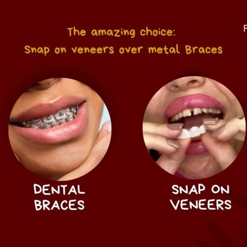 Best Snap On Veneers Reviews