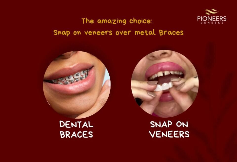 The amazing choice: Snap on veneers over metal Braces