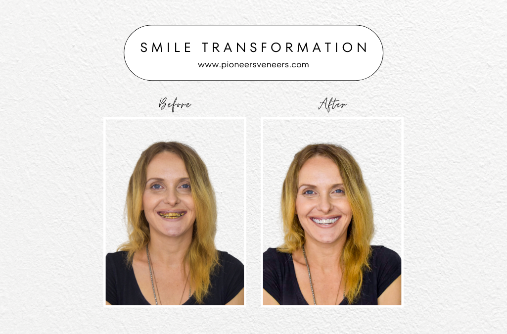 Wear Snap on veneers every day enjoy a new Smile