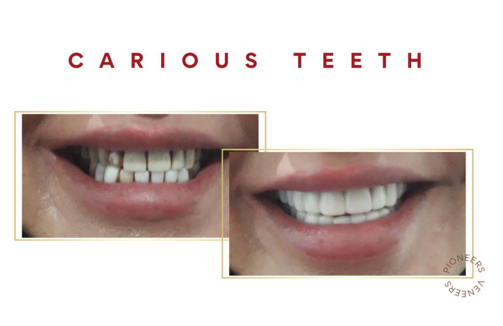 Carious Teeth