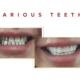 snap on veneers