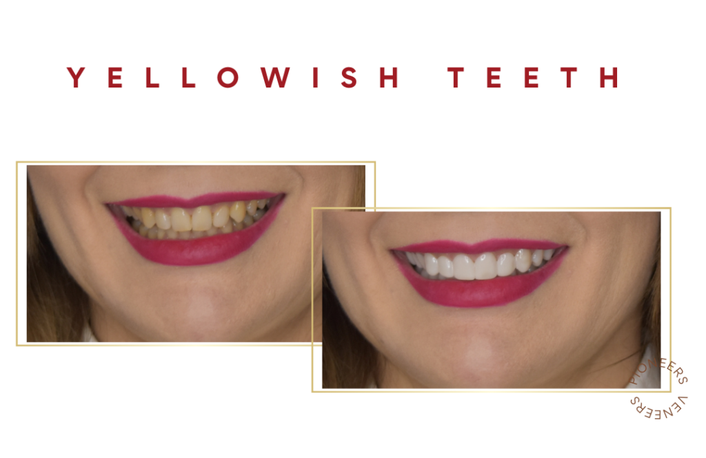 Yellowish Teeth