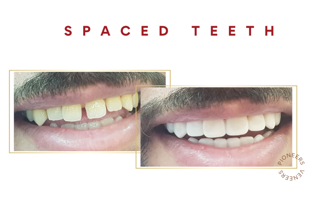 Spaced Teeth