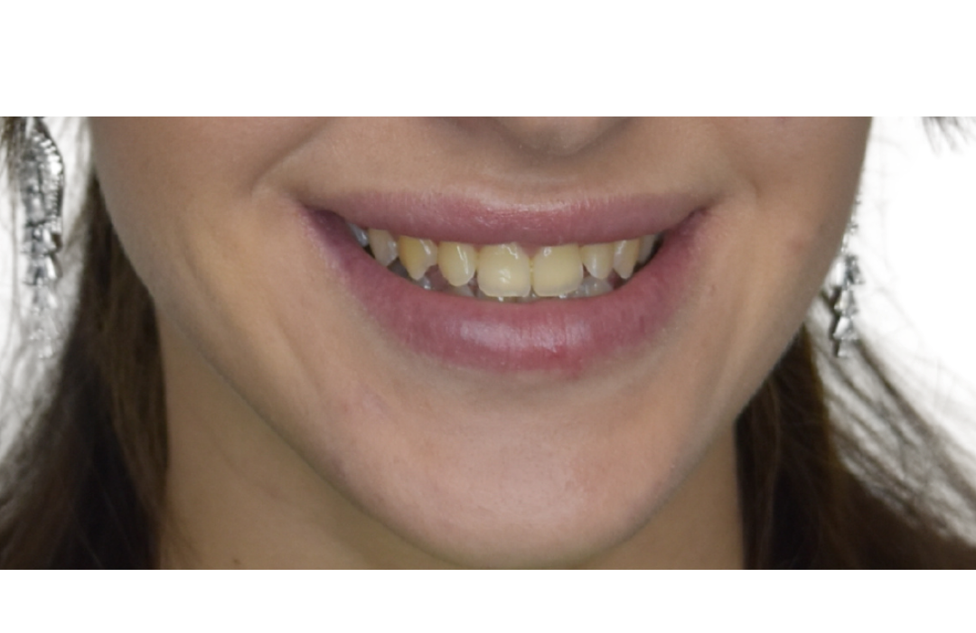 Natural Teeth