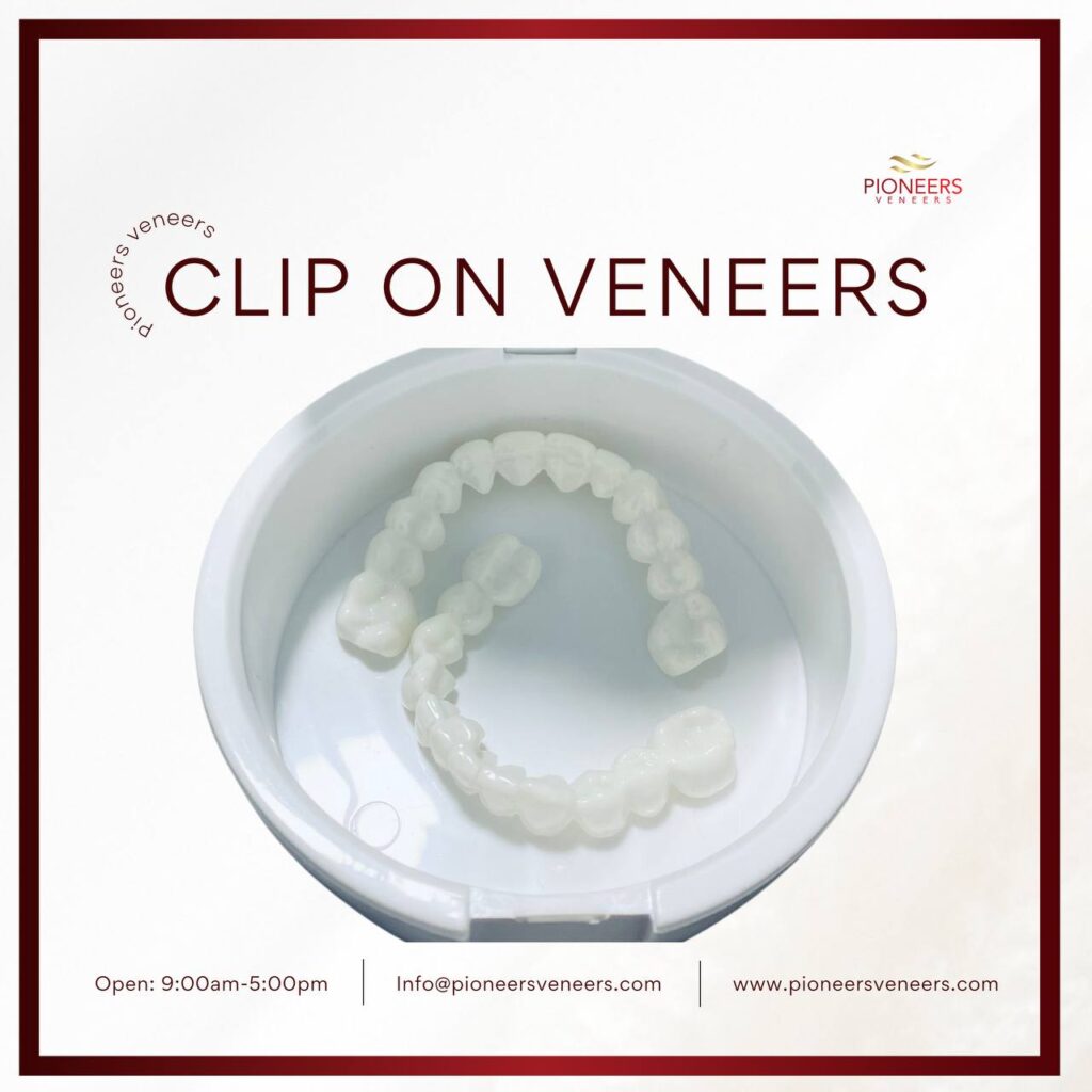 clip-on veneers