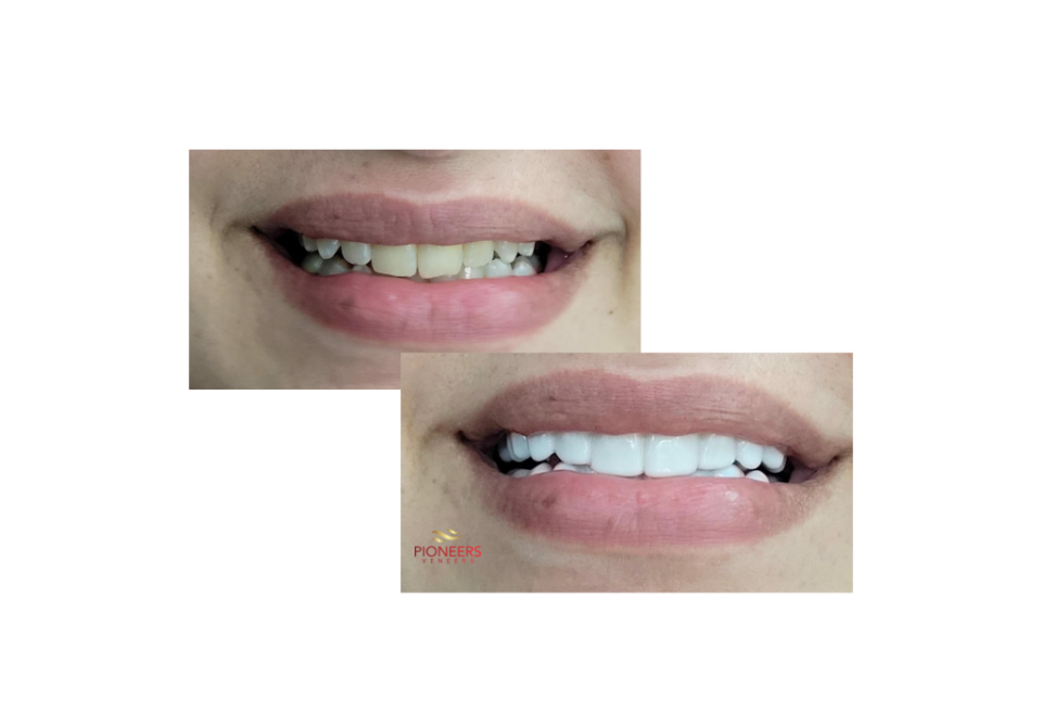 white teeth covers