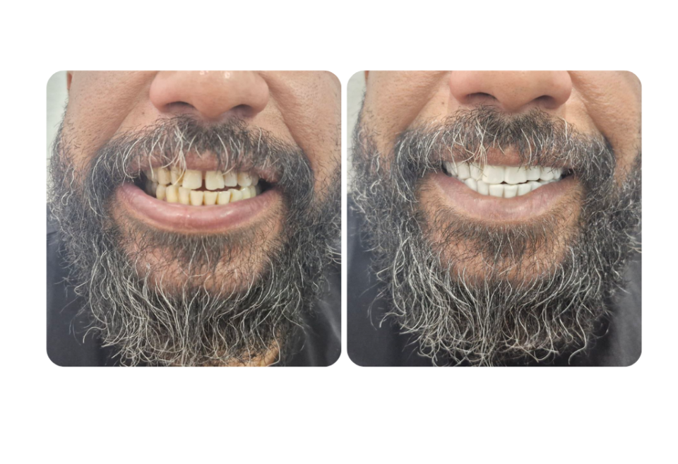 Clip on veneers