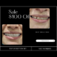 snap on veneers