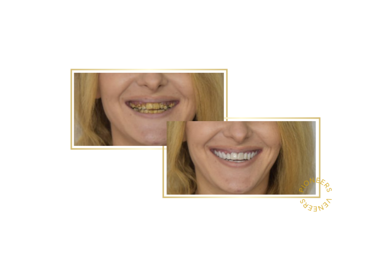 snap-on veneers