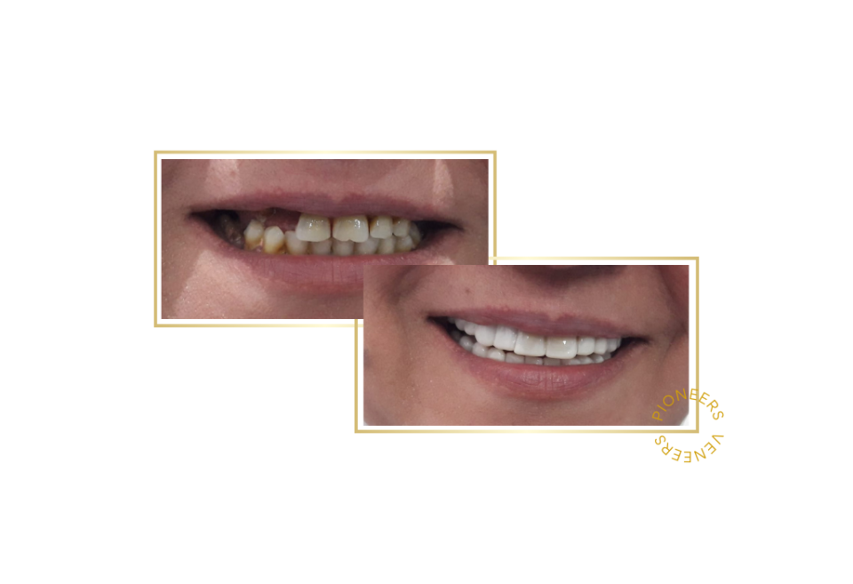 snap-on veneers