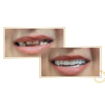 snap-on veneers