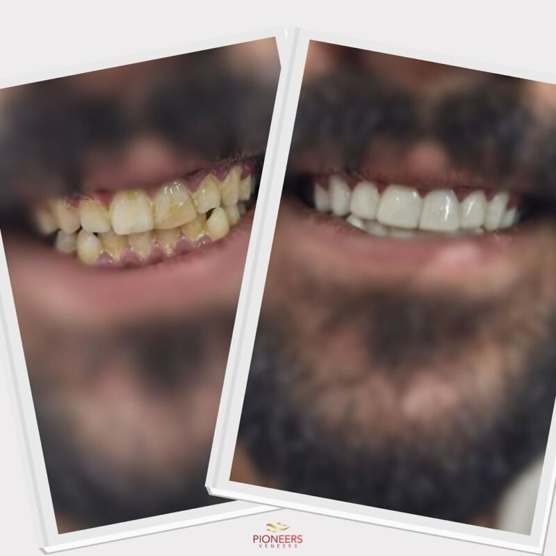 snap-on veneers