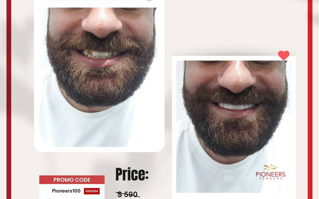 Clip-on veneers