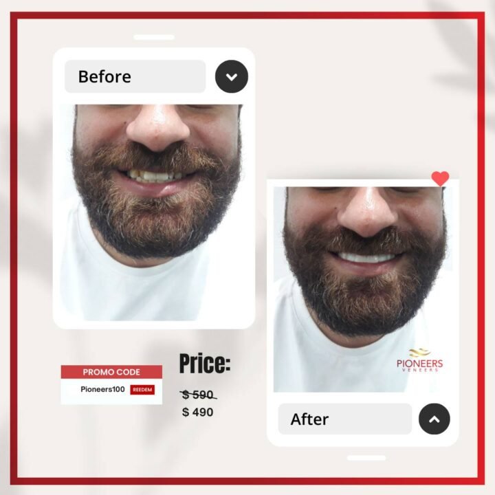 Clip-on veneers