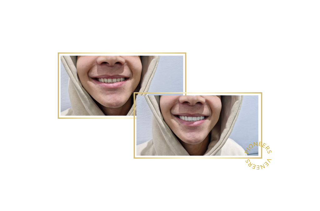 snap-on veneers
