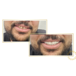 snap-on veneers
