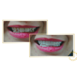 snap-on veneers
