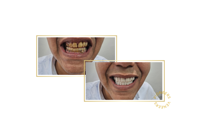 snap-on veneers