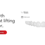 snap-on veneers