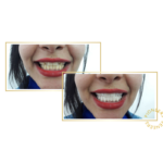 snap-on veneers