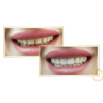 snap-on veneers
