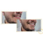 snap-on veneers