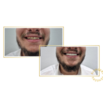 snap-on veneers