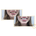 snap-on veneers