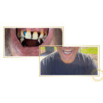 snap-on veneers