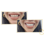 snap-on veneers