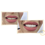 snap-on veneers