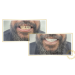 snap-on veneers