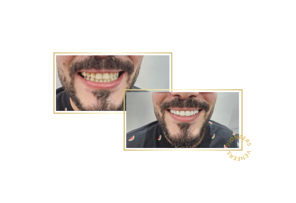 snap-on veneers