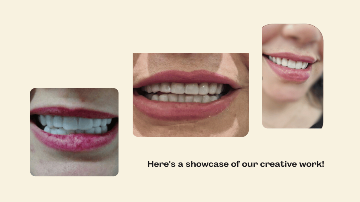 snap-on veneers