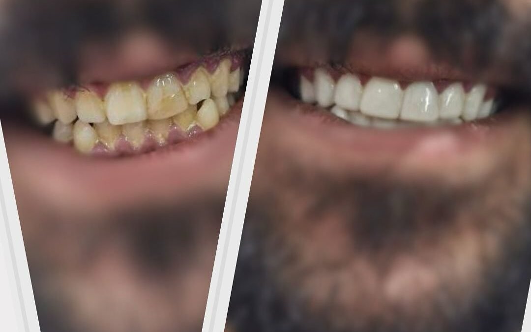 Snap-on veneers